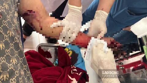 Điện thoại phát nổ, thiếu niên 16 tuổi ở Lâm Đồng bị thương nặng