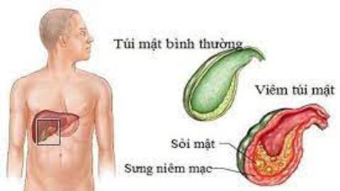 4 dấu hiệu cảnh báo bệnh lý sỏi mật