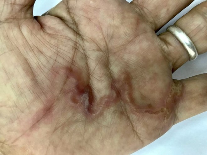 Nguy cơ thú cưng lây cho chủ nhân nhiễm ấu trùng giun đũa chó, mèo