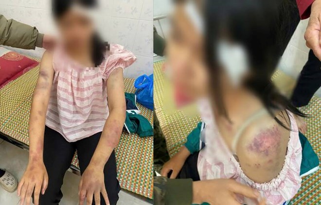 Bé gái bị bạo hành dã man tại Thái Nguyên