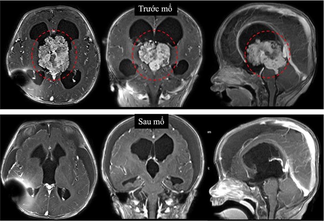 Cứu sống bệnh nhi 7 tháng tuổi có khối u não lớn
