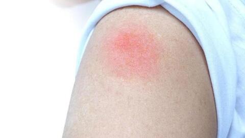 Xuất hiện hiện tượng 'cánh tay COVID' sau tiêm vaccine ở trẻ, cha mẹ xử trí thế nào?
