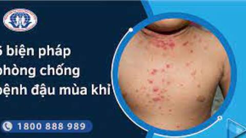 Khuyến cáo phòng, chống bệnh đậu mùa khỉ