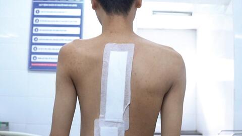Bệnh viện Đa khoa TP Vinh tiên phong chữa vẹo cột sống phức tạp