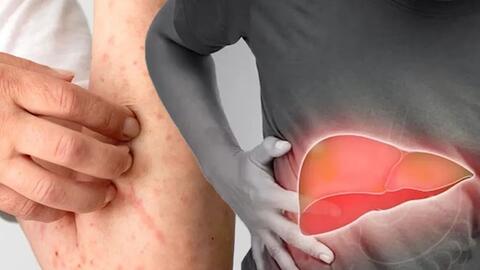 Biểu hiện trên da âm thầm cảnh báo gan đang gặp vấn đề