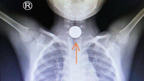 Cấp cứu bé trai 5 tuổi hóc đồng xu khi đi chúc Tết