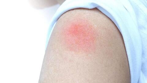 Xuất hiện hiện tượng 'cánh tay COVID' sau tiêm vaccine ở trẻ, cha mẹ xử trí thế nào?