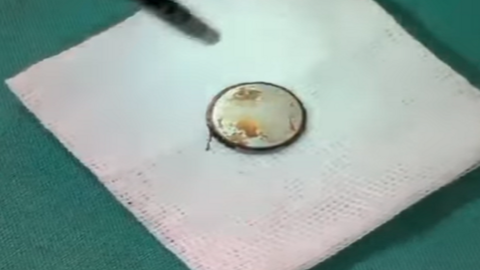 Viên pin tròn nằm trong thực quản bé 3 tuổi gần 1 tuần