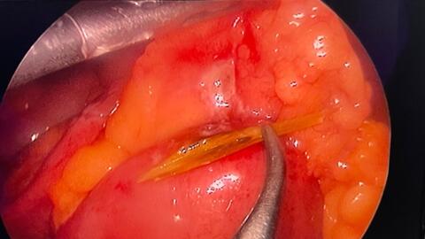 Thủng đường tiêu hóa do dị vật xương cá