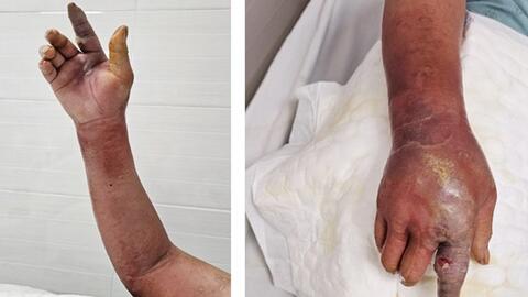 Nhiễm khuẩn huyết, sưng tấy tay do chó nhà cắn