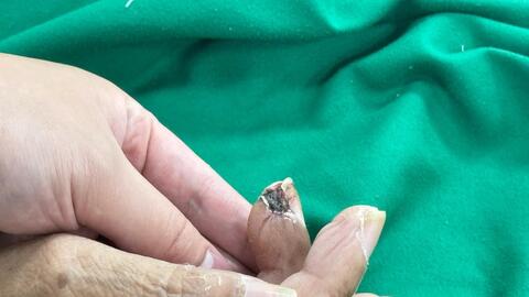 Nguy cơ mắc uốn ván nguy hiểm do vết thương hở