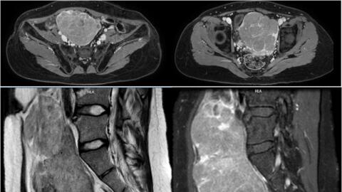 Bệnh viện Phương Đông phẫu thuật u loạn mầm buồng trứng hiếm gặp cho bệnh nhân 26 tuổi