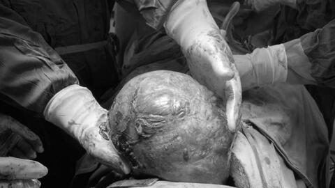 Phẫu thuật cho bệnh nhân có khối u "khủng" nặng hơn 2kg