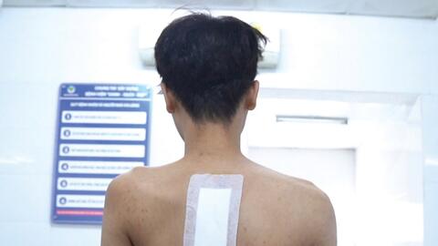 Bệnh viện Đa khoa TP Vinh tiên phong chữa vẹo cột sống phức tạp