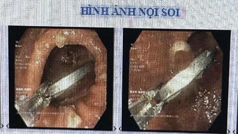 Nuốt dị vật khi chơi tiền xu, bé 11 tuổi nhập viện khẩn cấp