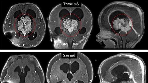 Cứu sống bệnh nhi 7 tháng tuổi có khối u não lớn