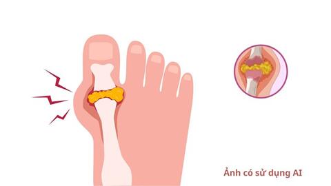 Không đau khớp vẫn có thể đối mặt nguy cơ từ axit uric cao