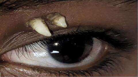 Ấn Độ ghi nhận ca bệnh răng mọc trên mắt lần đầu thấy trên thế giới