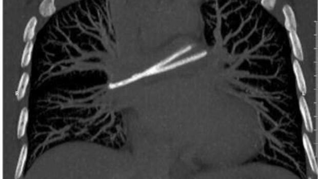 Ống truyền hóa chất bị đứt, âm thầm trôi vào tim suốt 3 năm