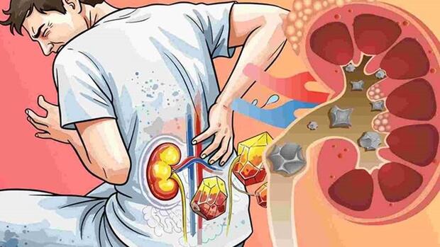 Nam giới có nguy cơ bị sỏi thận cao hơn phụ nữ