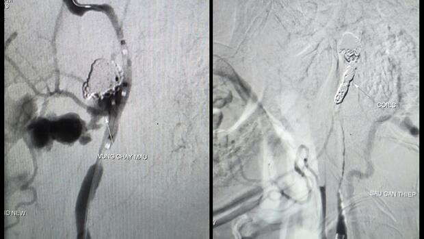 Bệnh nhân ung thư vòm hầu xuất huyết ồ ạt được cứu kịp thời