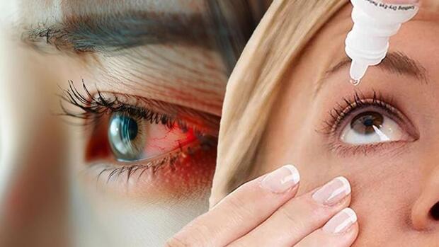 Viêm kết mạc do hóa chất: Triệu chứng và cách phòng ngừa