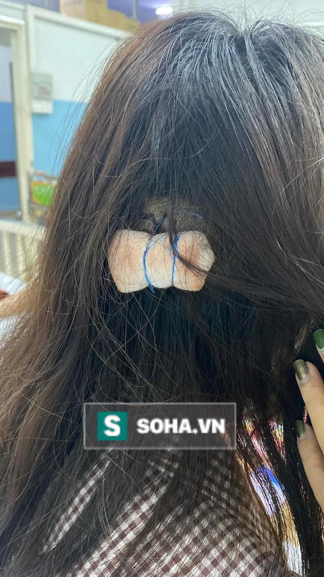 Cô gái bị tấn công vì mời bia không uống: Đứt gân tai khâu 15 mũi, đầu có 3 vết lõm sâu - Ảnh 3. Trên đầu nạn nhân có 3 vết hõm do bị đập ly và chai bia vào, 2 vết lớn đã phải khâu 6 mũi.