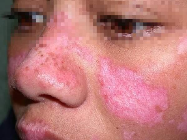 Bệnh Lupus ban đỏ có thể ảnh hưởng tới tất cả cơ quan trong cơ thể