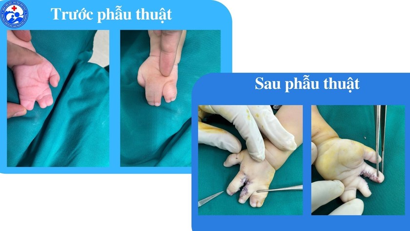 Bàn tay của bệnh nhân trước và sau phẫu thuật.