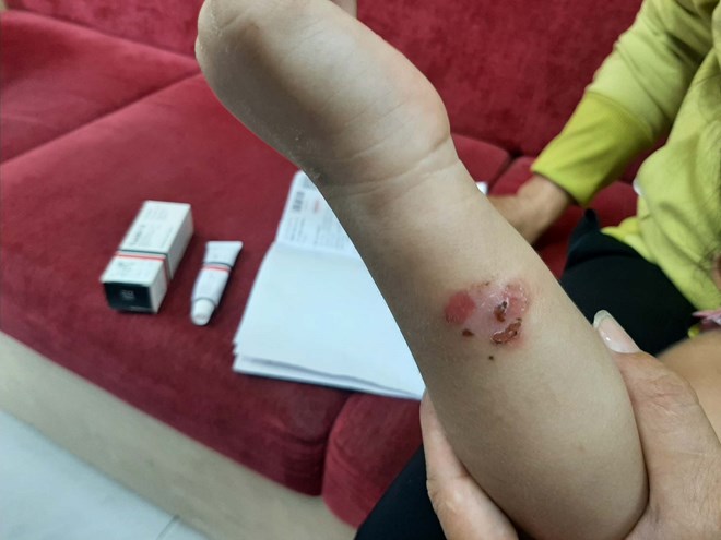 Đề phòng bệnh chốc lây lan nhanh ở trẻ
