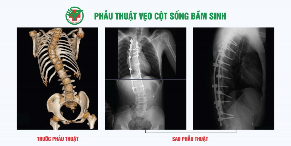 Phương pháp phẫu thuật vẹo cột sống bẩm sinh được thực hiện thành công tại Bệnh viện Đa khoa Thành phố Vinh