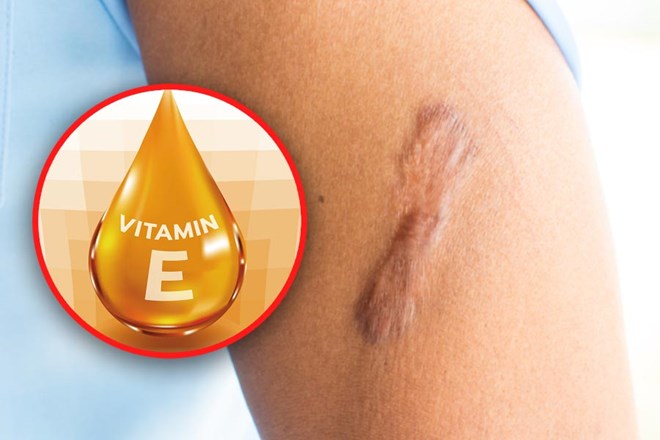 Bí quyết trị sẹo bằng vitamin E hiệu quả ngay tại nhà