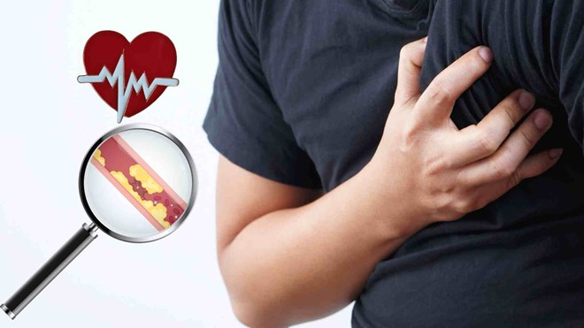2 dấu hiệu nguy cơ nhồi máu cơ tim, đột quỵ sau tập thể dục