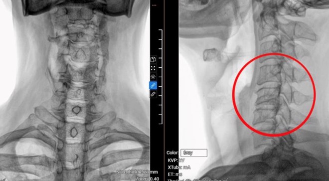 Thoát vị 3 đĩa đệm cổ do dùng điện thoại quá nhiều