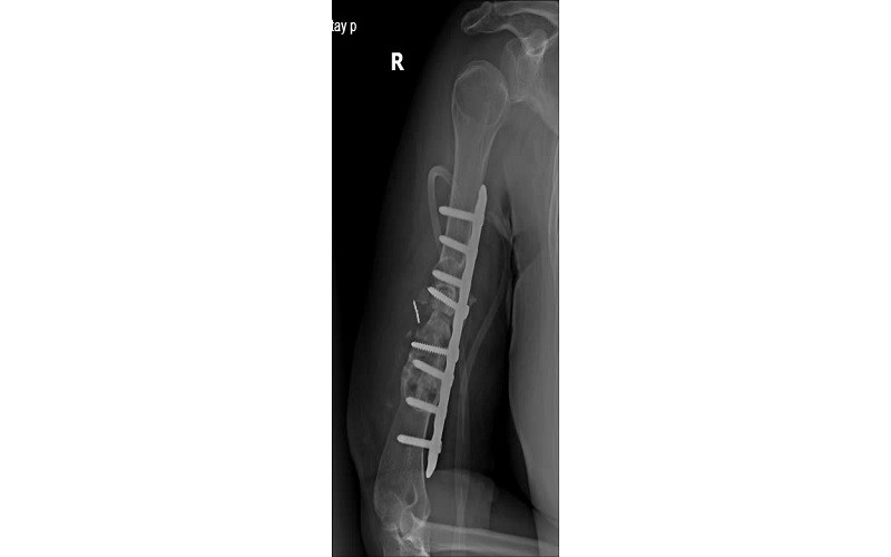 Tình trạng bệnh nhân sau khi mổ. Tình trạng bệnh nhân sau khi mổ.