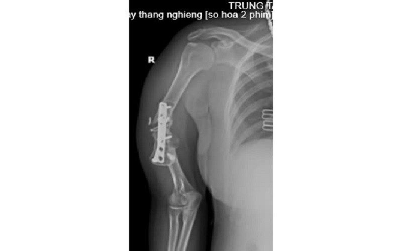 Tình trạng bệnh nhân trước khi mổ. Tình trạng bệnh nhân trước khi mổ.