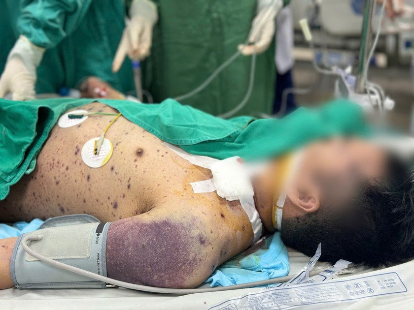 Bệnh nhân mắc thuỷ đậu đang được điều trị tại Bệnh viện Bệnh Nhiệt đới Trung ương. Ảnh: Thanh Thanh. Bệnh nhân mắc thuỷ đậu đang được điều trị tại Bệnh viện Bệnh Nhiệt đới Trung ương. Ảnh: Thanh Thanh.