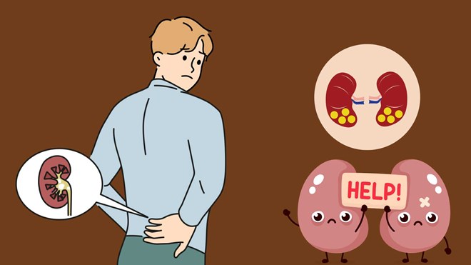 6 yếu tố có thể liên quan đến sự hình thành sỏi thận