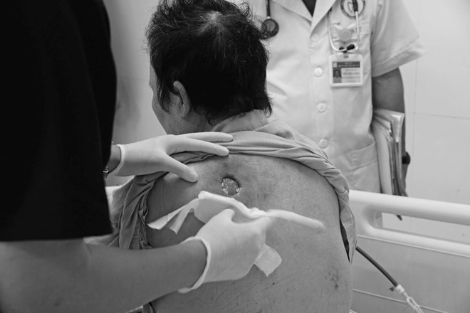 Bệnh nhân đái tháo đường nguy kịch vì uống nước đường giải độc theo thầy lang
