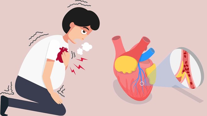 3 biểu hiện cảnh báo nhồi máu cơ tim dễ bị bỏ qua