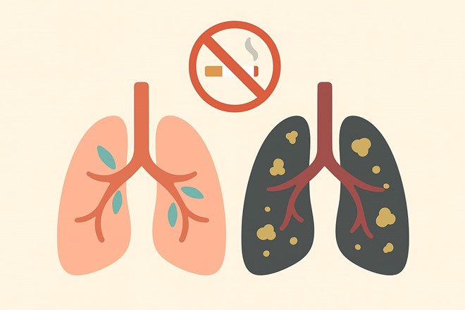 Hút thuốc lá lâu năm, bệnh nhân hối hận thì đã phải đối mặt với ung thư giai đoạn cuối