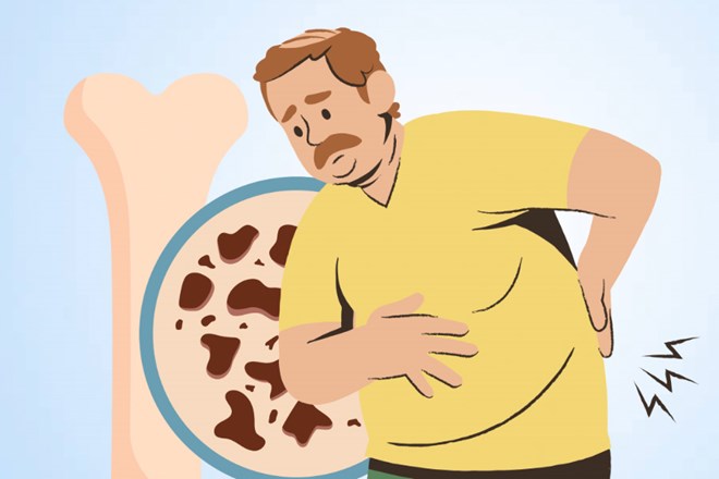 Loãng xương và gãy xương: Vai trò của phát hiện sớm trong phòng ngừa