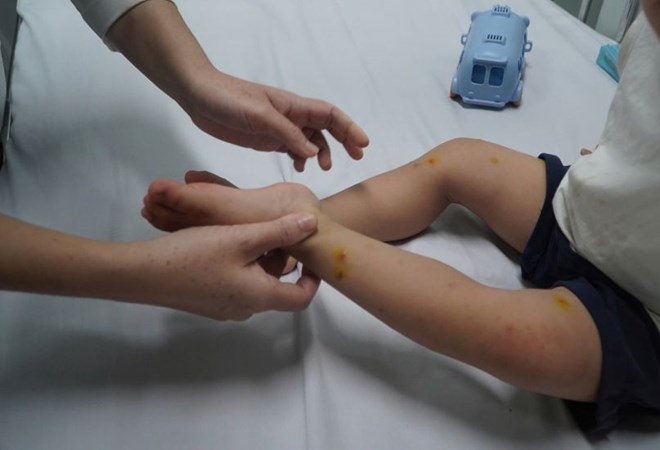 Nhiều trẻ nhập viện vì tay chân miệng ở TPHCM