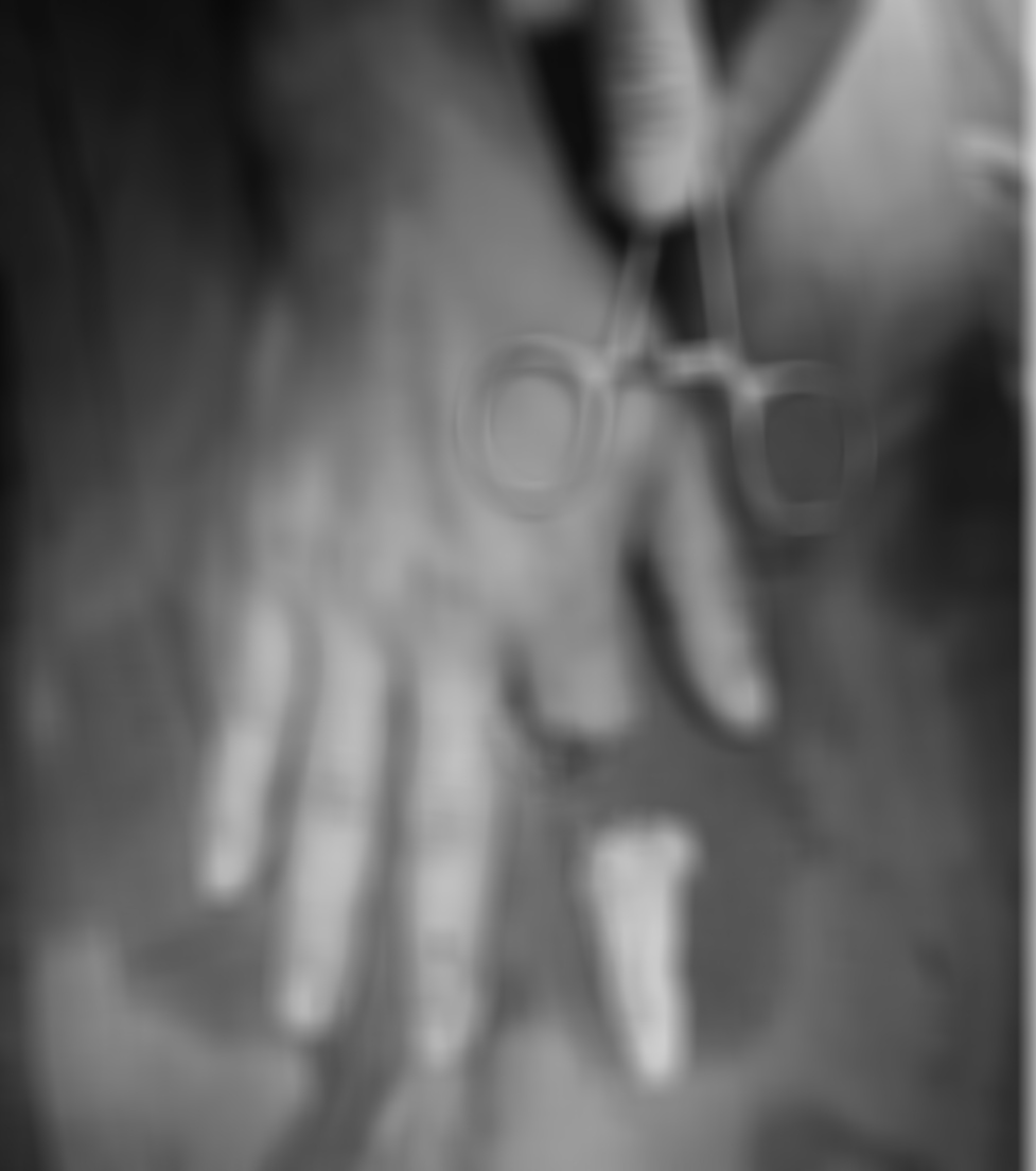 Hình ảnh ngón tay trỏ đứt rời của bệnh nhân trước phẫu thuật vi phẫu nối ngón tay. Ảnh: BVCC