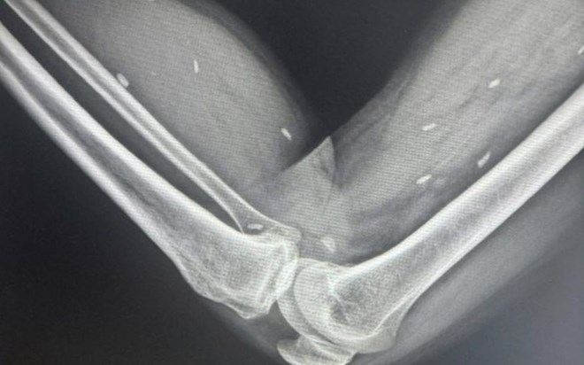 Nhiễm kén sán ở vùng đùi và cẳng chân của bệnh nhân tại Quảng Trị