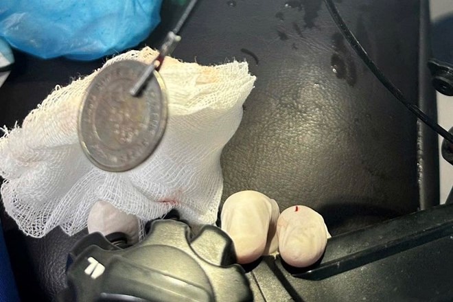 Nuốt dị vật khi chơi tiền xu, bé 11 tuổi nhập viện khẩn cấp