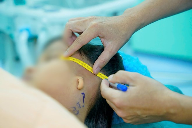 Phẫu thuật tạo hình tai nhỏ giúp trẻ cải thiện thẩm mỹ, thính lực