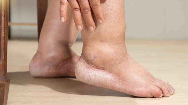 Bác sĩ cảnh báo nguy cơ tổn thương thận khi axit uric tăng cao
