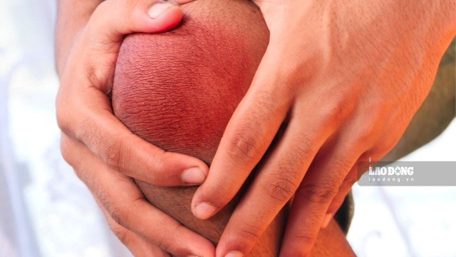 Dấu hiệu cảnh báo axit uric tăng cao, nên đi khám sớm